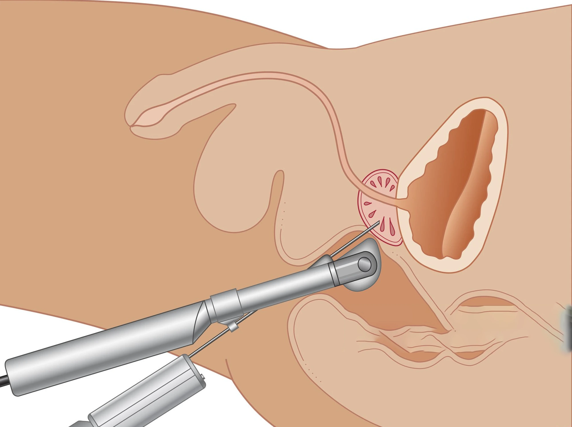Ilustração anatômica da biópsia de próstata guiada por ultrassonografia