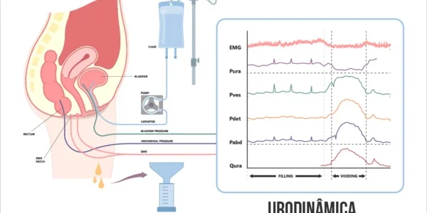 Estudo-Urodinamico-com-Eletromiografia